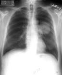 lung cancer