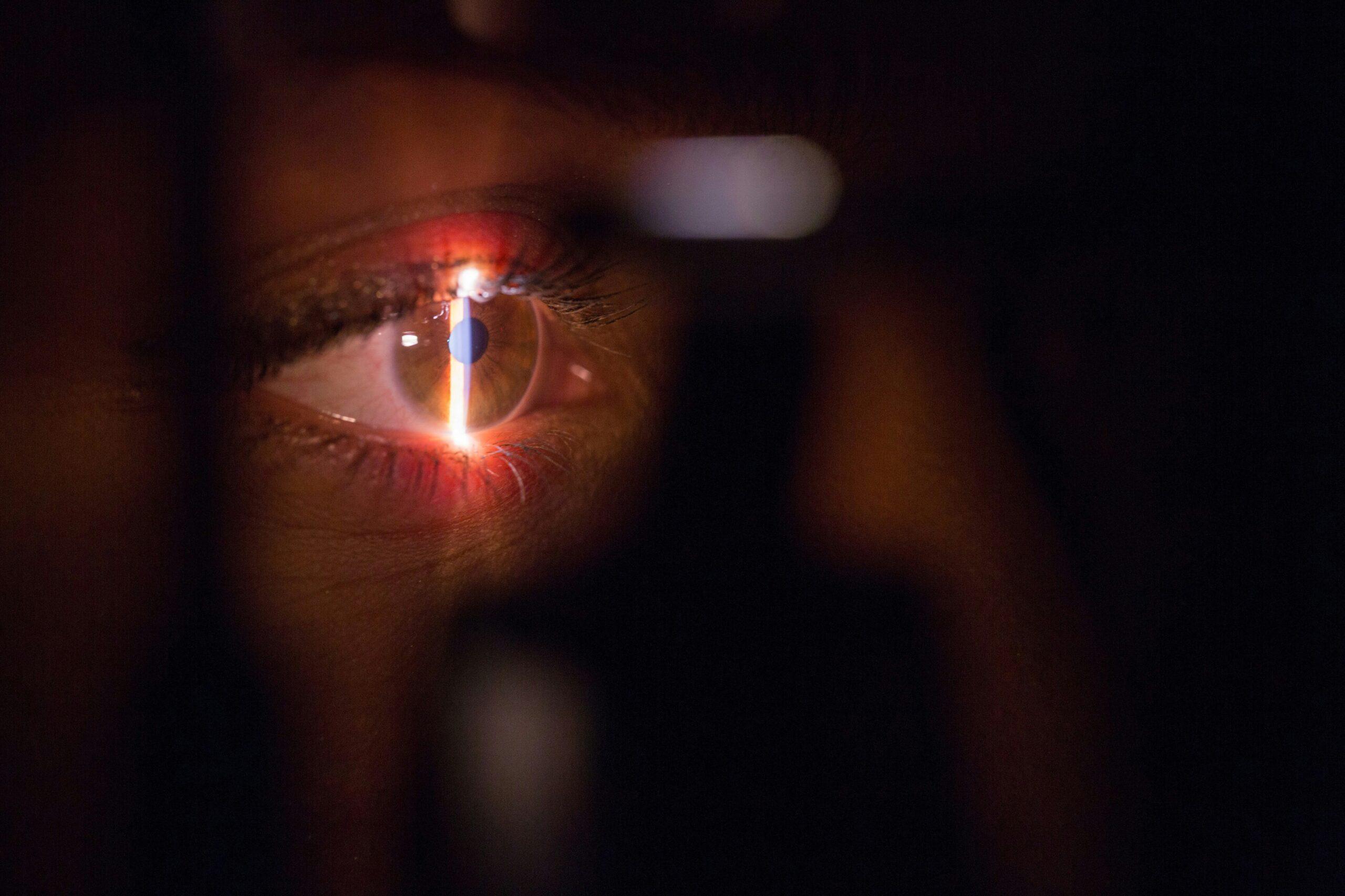 A close-up of an eye undergoing an ophthalmic exam, illuminated by a narrow beam of light from specialized diagnostic equipment in a dimly lit setting.