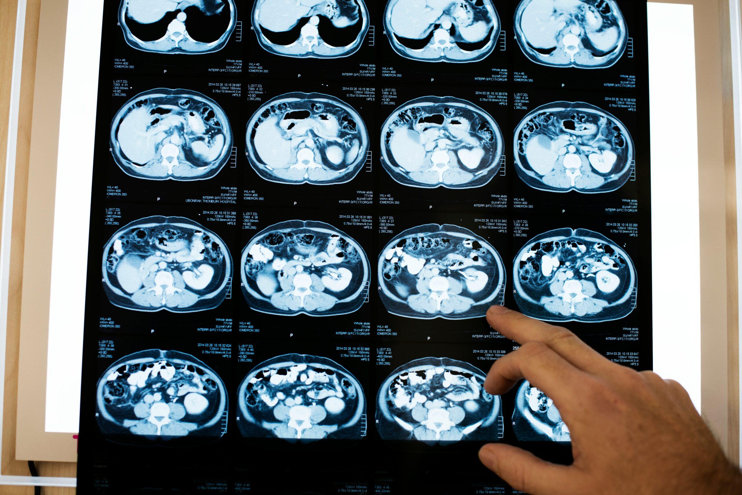 A medical imaging film displaying multiple abdominal CT scan slices arranged in a grid, illuminated on a lightbox, with a person’s hand pointing to a specific scan showing internal organs and contrast details.