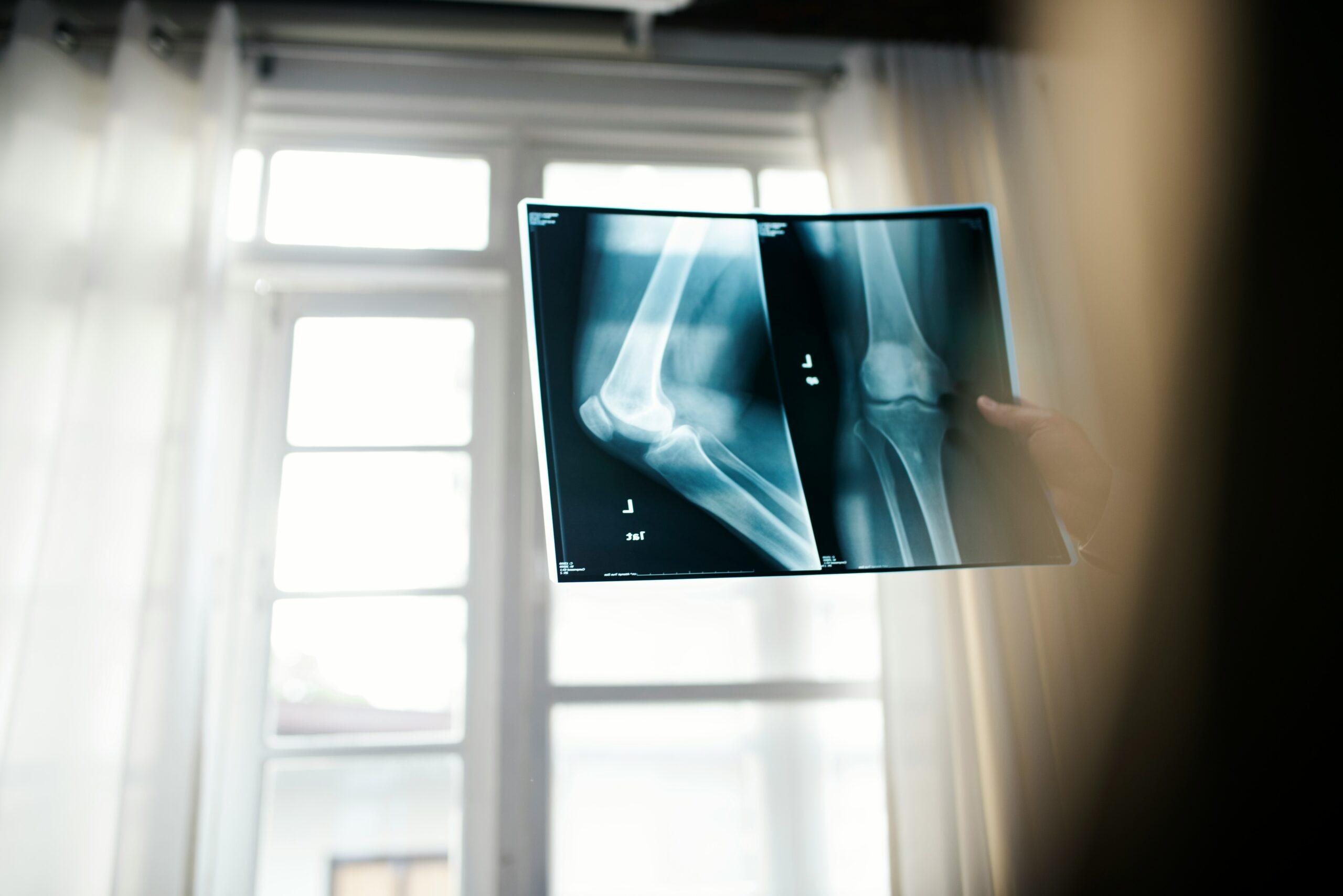 A doctor holding up an X-ray film of a human knee in front of a bright window, showing two detailed radiographic views of the joint with the surrounding room softly blurred in the background.
